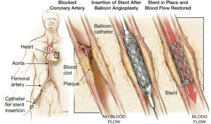 Coronary artery angioplasty and stenting